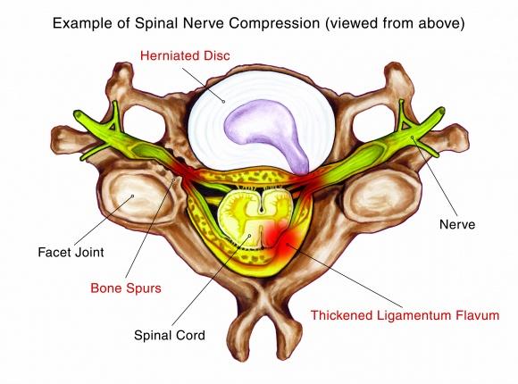 spinal disorders causing nerve compression