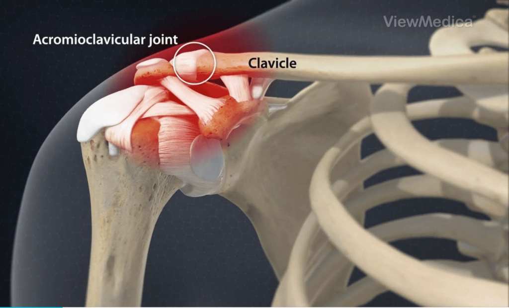 Prestige Pain Centers - Intraarticular Steroid Injections