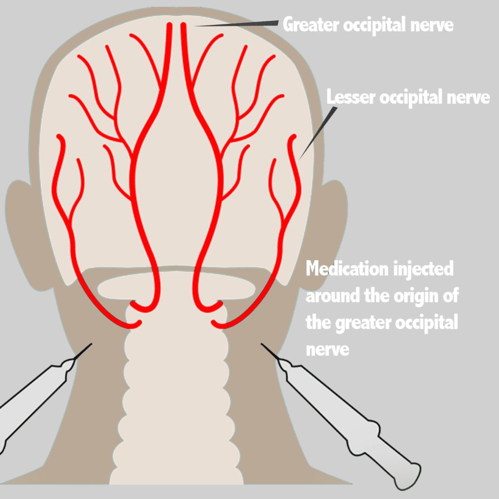 Prestige Pain Centers - Nerve Blocks Occipital to Ilioinguinal