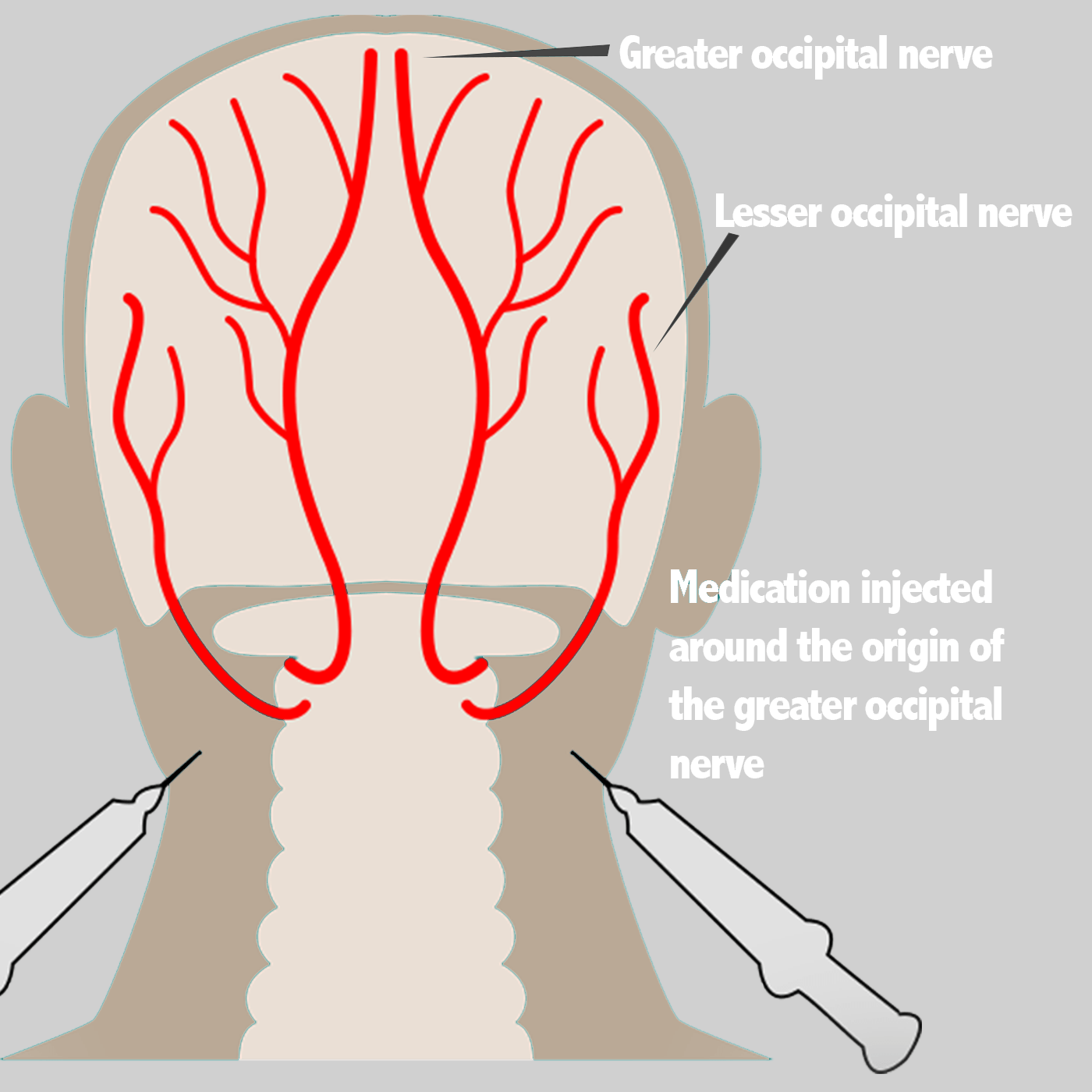 Prestige Pain Centers - Nerve Blocks Occipital To Ilioinguinal